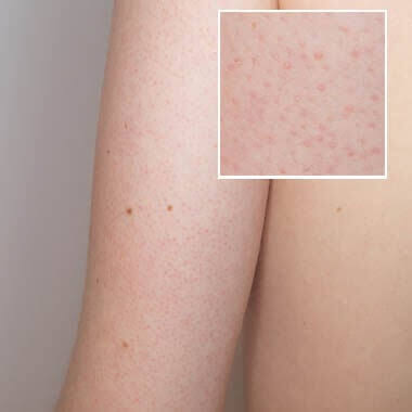 Keratosis Pilaris: Understanding the "Chicken Skin" Condition